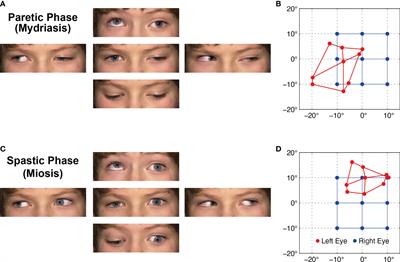 Case Report: Oculomotor Palsy With Cyclic Spasms in a Patient With Charcot-Marie-Tooth Disease Type 1